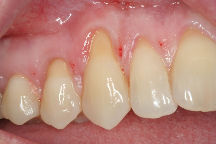 Kelowna Periodontist Vernon Okanagan | Gingival Augmentation